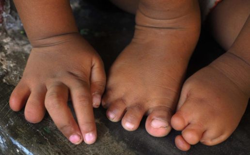 Child's hands and feet deformed by mercury poisoning from gold mining in Amazon