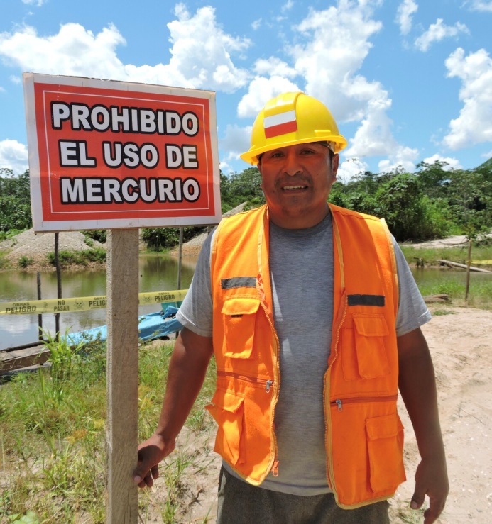 Child's hands and feet deformed by mercury poisoning from gold mining in Amazon